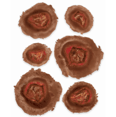 Small Ulcer, Dark Set 6