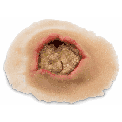 Ulcer Small Light Single