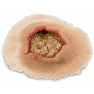 Ulcer Small Sngl Manikin