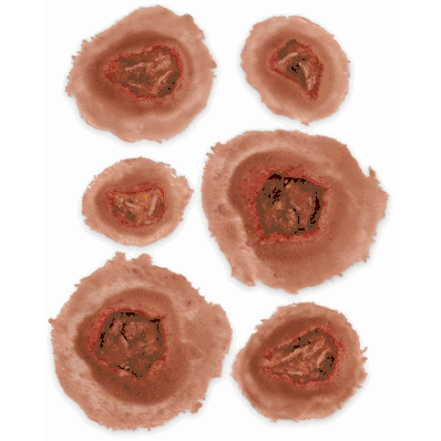 Small Ulcer, Medium St 6