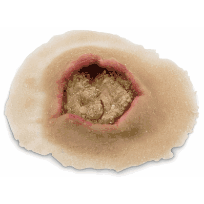 Small Ulcer, Mankn Set 6