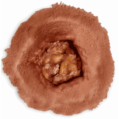 Small Ulcer, Medium Single