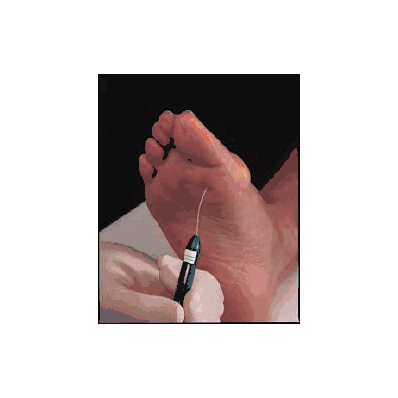Neuropathy Screening Pen