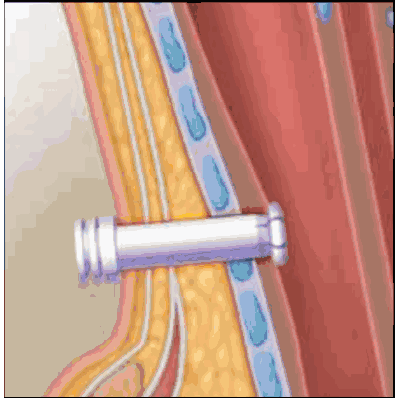 Olympic Trach-Button, 40 mm, Adjustable to 28 mm, 11 mm OD