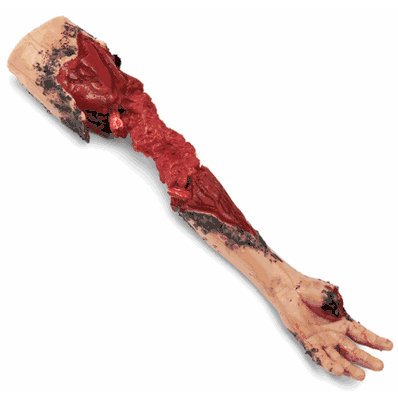 Arm Partial Amuptn Left Light