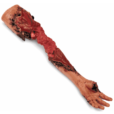 Arm Partial Amuptn Left Medium