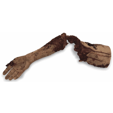 Arm Partl Amputation Righ Mankin