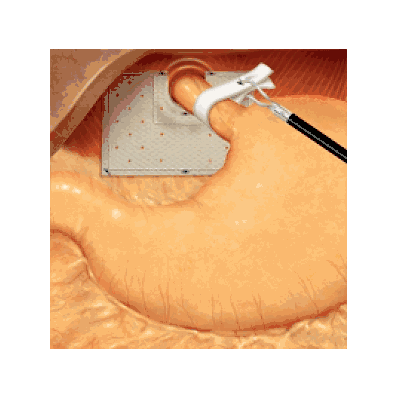 Patch Surgises Paraesophegeal - Medline