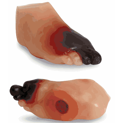Severe Diabetic Foot Model