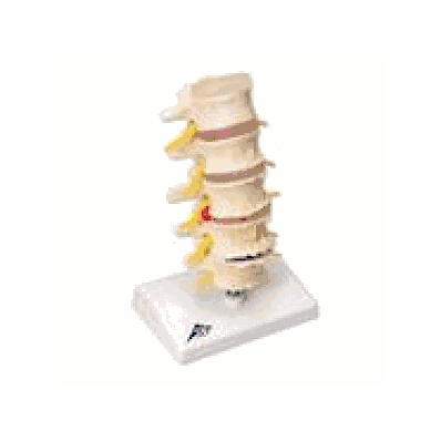 Stages of disc prolapse and vertebral degeneration