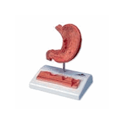 Stomach with Ulcers