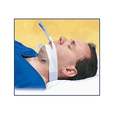 Trachtape, Endotrach'L Tube Secur'G Devic