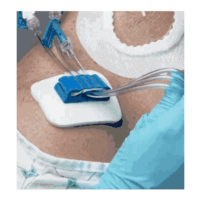 Tubing Anchor, ANC32XT, Sites: CVC-Subclavian, CVC-Jugular, CVC-Femoral