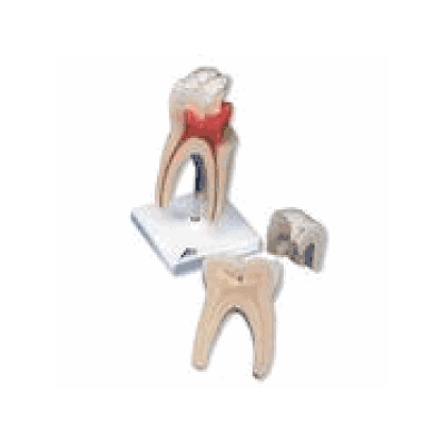 Upper Triple-root Molar, 3 Part