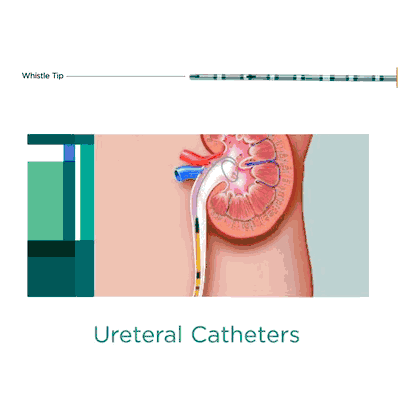 Ureteral Catheter, 4 Fr Whistle Tip