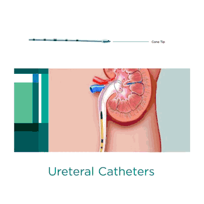 Ureteral Catheter, 6 FR Terminol Cone Tip