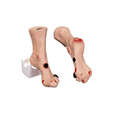 Wound Foot Model