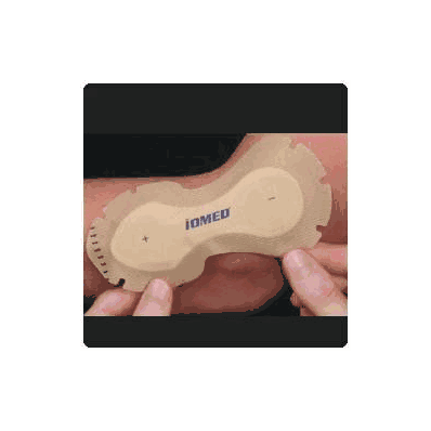 Wireless Iontophoresis System Companion 80 1