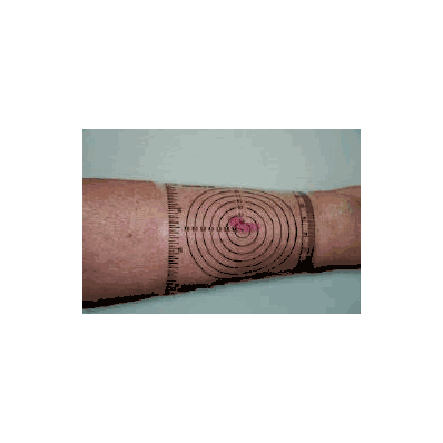 Wound Measuring Guide Ibnonsterile - Wound Di